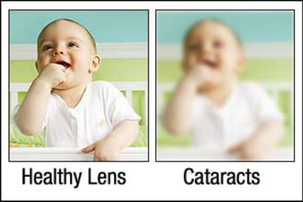 Cataracts Cherokee
